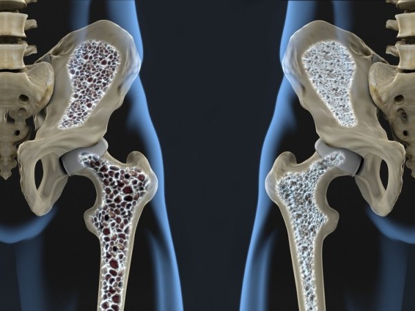 REMODELING OSSEO E&nbsp;OSTEOPOROSI
